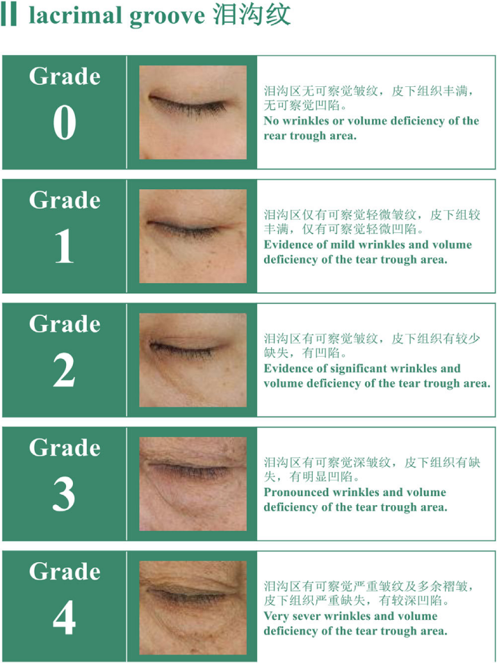 中國女性淚溝紋分級標準-上海市皮膚病醫院