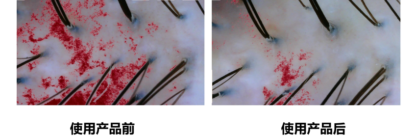 頭皮健康,紅斑,,丘疹,膿皰,評價方法