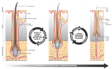 頭發,脫發,雄激素,脂溢性脫發,免疫系統,胰島素